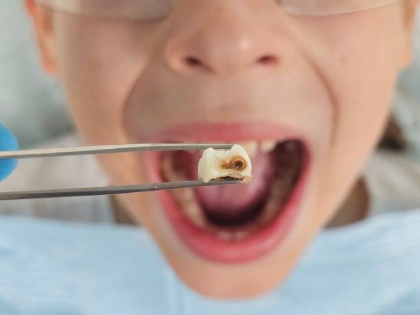Best Emergency Tooth Extraction in The Crossings, FL